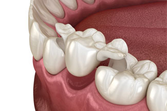 dental-bridge